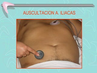 AUSCULTACION A. ILIACAS
 