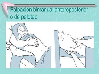 Palpación bimanual anteroposterior
o de peloteo
 