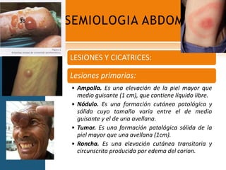 SEMIOLOGIA ABDOMINAL38