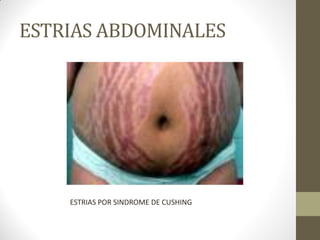 ESTRIAS ABDOMINALES
ESTRIAS POR SINDROME DE CUSHING
 