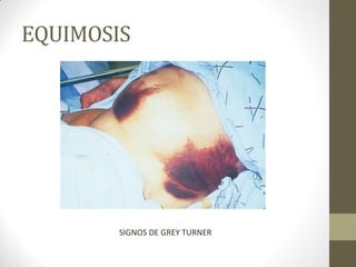 EQUIMOSIS
SIGNOS DE GREY TURNER
 