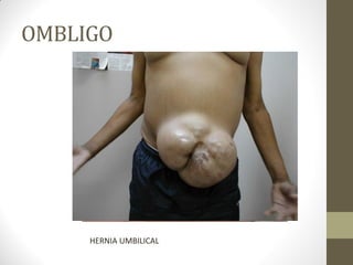 OMBLIGO
HERNIA UMBILICAL
 