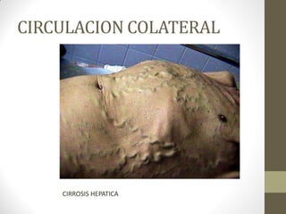 CIRCULACION COLATERAL
CIRROSIS HEPATICA
 