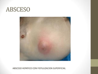 ABSCESO
ABSCESO HEPATICO CON FISTULIZACION SUPERFICIAL
 