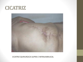 CICATRIZ
CICATRIZ QUIRURGICA SUPRA E INFRAUMBILICAL
 
