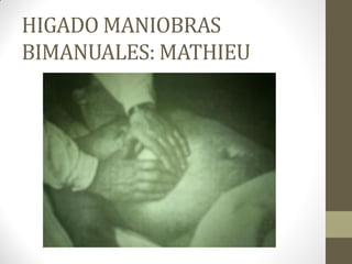 HIGADO MANIOBRAS
BIMANUALES: MATHIEU
 