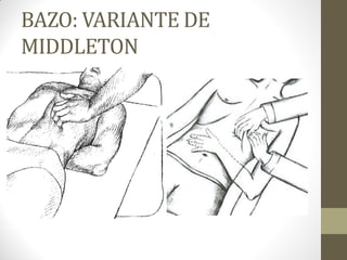 BAZO: VARIANTE DE
MIDDLETON
 