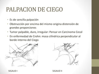 PALPACION DE CIEGO
• Es de sencilla palpación
• Obstrucción por encima del mismo origina distensión de
grandes proporciones
• Tumor palpable, duro, irregular: Pensar en Carcinoma Cecal
• En enfermedad de Crohn: masa cilíndrica perpendicular al
borde interno del Ciego
SIGAUD I SIGAUD II
 