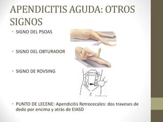 APENDICITIS AGUDA: OTROS
SIGNOS
• SIGNO DEL PSOAS
• SIGNO DEL OBTURADOR
• SIGNO DE ROVSING
• PUNTO DE LECENE: Apendicitis Retrocecales: dos traveses de
dedo por encima y atrás de EIASD
 