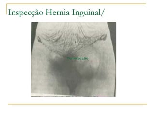 Inspecção Hernia Inguinal/
Tumefacção
 