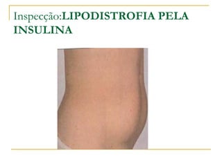 Inspecção:LIPODISTROFIA PELA
INSULINA
 