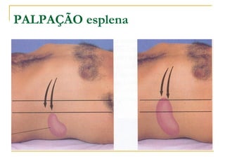 PALPAÇÃO esplena
 