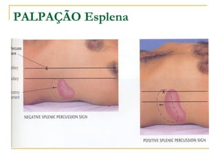 PALPAÇÃO Esplena
 