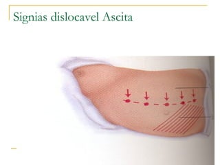 Signias dislocavel Ascita
 
