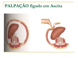 PALPAÇÃO figado em Ascita
 