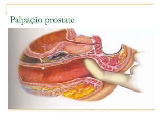 Palpação prostate
 