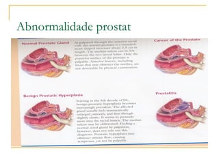 Abnormalidade prostat
 