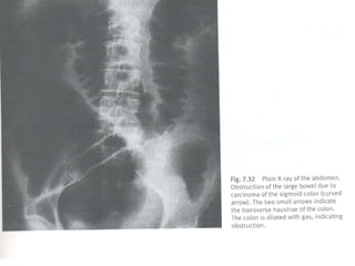 Semiologia abdominal final