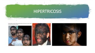 HIPERTRICOSIS
 