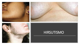 HIRSUTISMO
 