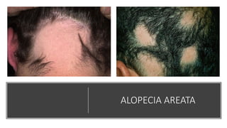 ALOPECIA AREATA
 