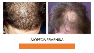 ALOPECIA FEMENINA
 