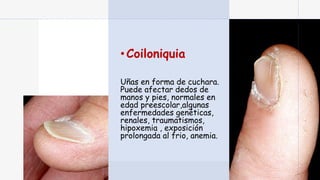•Coiloniquia
Uñas en forma de cuchara.
Puede afectar dedos de
manos y pies, normales en
edad preescolar,algunas
enfermedades genéticas,
renales, traumatismos,
hipoxemia , exposición
prolongada al frio, anemia.
 