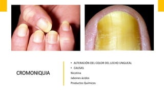 CROMONIQUIA
• ALTERACIÓN DEL COLOR DEL LECHO UNGUEAL
• CAUSAS
Nicotina
Jabones ácidos
Productos Químicos
 