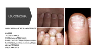 LEUCONIQUIA
MANCHAS BLANCAS TRANSVERSALES
CAUSAS
TRAUMATISMOS
PROBLEMAS VASCULARES
PROBLEMAS SISTÉMICOS ( variaciones
hormonales,anemia, psoriasis vitíligo)
QUIMIOTERAPIA
MEDICAMENTOS
 