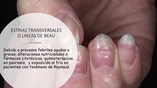 ESTRIAS TRANSVERSALES
O LINEAS DE BEAU
Debido a procesos febriles agudos o
graves, alteraciones nutricionales o
fármacos citotóxicos, quimioterápicos,
en psoriasis, y exposición al frío en
pacientes con fenómeno de Reynaud.
 
