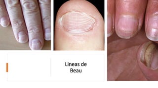 Lineas de
Beau
 