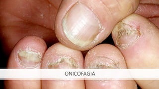 ONICOFAGIA
 