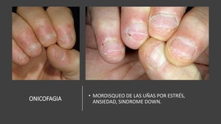 ONICOFAGIA
• MORDISQUEO DE LAS UÑAS POR ESTRÉS,
ANSIEDAD, SINDROME DOWN.
 