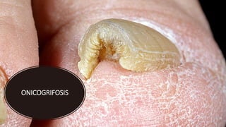 ONICOGRIFOSIS
 