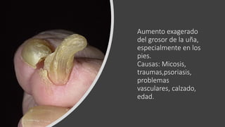 Aumento exagerado
del grosor de la uña,
especialmente en los
pies.
Causas: Micosis,
traumas,psoriasis,
problemas
vasculares, calzado,
edad.
 
