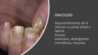 ONICOLOSIS
Desprendimiento de la
uña por su parte distal o
lateral.
Causas:
psoariasis, detergentes,
cosméticos, traumas.
 