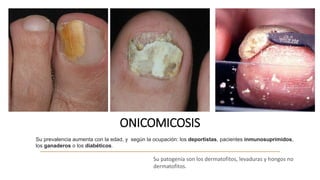 ONICOMICOSIS
Su prevalencia aumenta con la edad, y según la ocupación: los deportistas, pacientes inmunosuprimidos,
los ganaderos o los diabéticos.
Su patogenia son los dermatofitos, levaduras y hongos no
dermatofitos.
 
