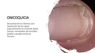 ONICOQUICIA
Descamación en láminas con
separación de las capas
especialmente en el borde distal,
Causas: removedor de esmaltes
lavado y secado continuo
Trauma
 