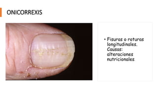 ONICORREXIS
• Fisuras o roturas
longitudinales.
Causas:
alteraciones
nutricionales.
 