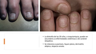 • La distrofia de las 20 uñas, o traquioniquia, puede ser
secundaria a enfermedades sistémicas o de carácter
idiopático.
• Se relaciona a psoriasis, liquen plano, dermatitis
atópica, alopecia areata.
 
