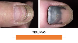 TRAUMAS
 