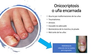 Onicocriptosis
o uña encarnada
• Ocurre por malformaciones de las uñas
• Traumatismos
• Artrosis
• Causado no adecuado
• Biomecánica de la marcha y la pisada
• Mal corte de las uñas
PARONIQUIA
infección de los tejidos
periungueales.
 