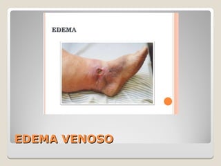EDEMA VENOSOEDEMA VENOSO
 