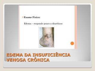 EDEMA DA INSUFICIÊNCIAEDEMA DA INSUFICIÊNCIA
VENOSA CRÔNICAVENOSA CRÔNICA
 