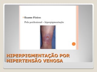 HIPERPIGMENTAÇÃO PORHIPERPIGMENTAÇÃO POR
HIPERTENSÃO VENOSAHIPERTENSÃO VENOSA
 
