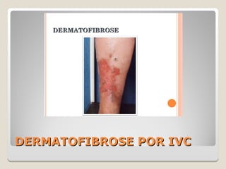 DERMATOFIBROSE POR IVCDERMATOFIBROSE POR IVC
 