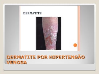 DERMATITE POR HIPERTENSÃODERMATITE POR HIPERTENSÃO
VENOSAVENOSA
 