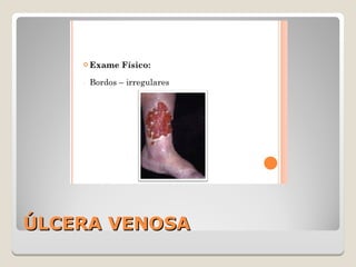 ÚLCERA VENOSAÚLCERA VENOSA
 