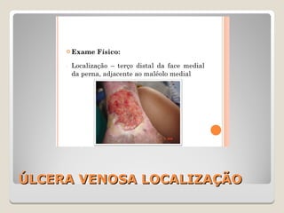 ÚLCERA VENOSA LOCALIZAÇÃOÚLCERA VENOSA LOCALIZAÇÃO
 
