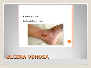 ULCERA VENOSAULCERA VENOSA
 